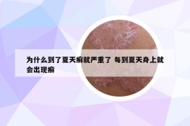 为什么到了夏天癣就严重了 每到夏天身上就会出现癣