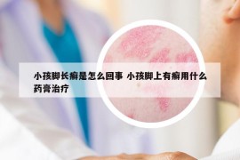 小孩脚长癣是怎么回事 小孩脚上有癣用什么药膏治疗