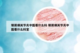 银屑病关节炎中医看什么科 银屑病关节炎中医看什么科室