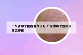 广东省哪个医院治白斑好 广东省哪个医院治白斑好些