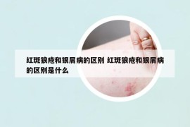 红斑狼疮和银屑病的区别 红斑狼疮和银屑病的区别是什么