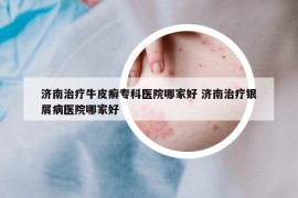 济南治疗牛皮癣专科医院哪家好 济南治疗银屑病医院哪家好