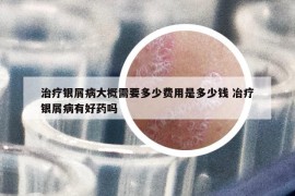 治疗银屑病大概需要多少费用是多少钱 冶疗银屑病有好药吗