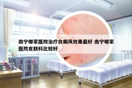 南宁哪家医院治疗白癜风效果最好 南宁哪家医院皮肤科比较好