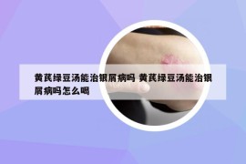 黄芪绿豆汤能治银屑病吗 黄芪绿豆汤能治银屑病吗怎么喝