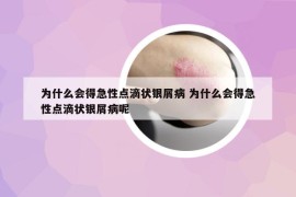 为什么会得急性点滴状银屑病 为什么会得急性点滴状银屑病呢