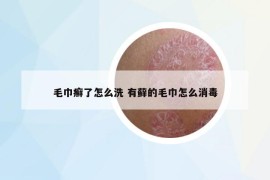 毛巾癣了怎么洗 有藓的毛巾怎么消毒