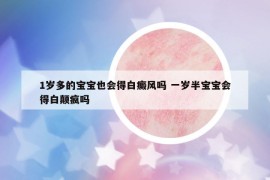 1岁多的宝宝也会得白癜风吗 一岁半宝宝会得白颠疯吗