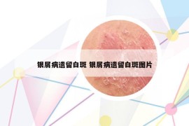 银屑病遗留白斑 银屑病遗留白斑图片