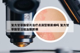 复方甘草酸苷片治疗点滴型银屑病吗 复方甘草酸苷注射治银屑病