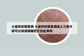 小面积的银屑病 小面积的银屑病插上三摩卡醇可以用保鲜膜把它包起来吗