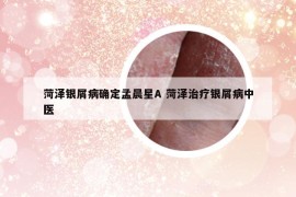 菏泽银屑病确定孟晨星A 菏泽治疗银屑病中医