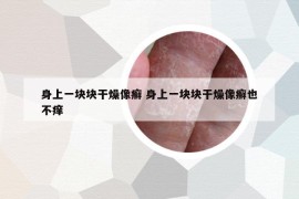 身上一块块干燥像癣 身上一块块干燥像癣也不痒