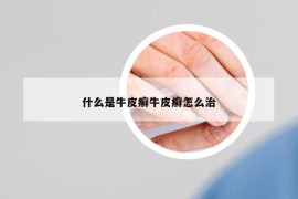 什么是牛皮癣牛皮癣怎么治