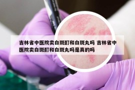 吉林省中医院卖白斑酊和白斑丸吗 吉林省中医院卖白斑酊和白斑丸吗是真的吗