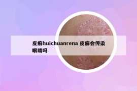 皮癣huichuanrena 皮癣会传染眼睛吗