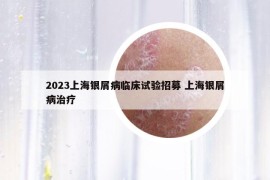 2023上海银屑病临床试验招募 上海银屑病治疗