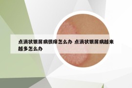 点滴状银屑病很痒怎么办 点滴状银屑病越来越多怎么办