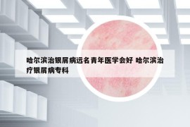 哈尔滨治银屑病远名青年医学会好 哈尔滨治疗银屑病专科