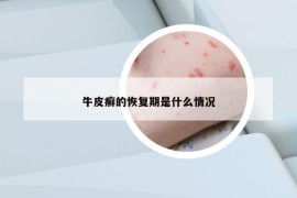 牛皮癣的恢复期是什么情况