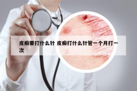 皮癣要打什么针 皮癣打什么针管一个月打一次