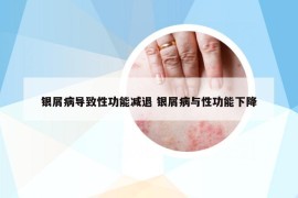 银屑病导致性功能减退 银屑病与性功能下降