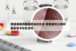 银屑病用丙酸倍他米松乳膏 银屑病可以用丙酸氟替卡松乳膏吗