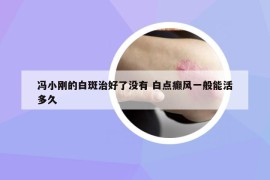 冯小刚的白斑治好了没有 白点癫风一般能活多久