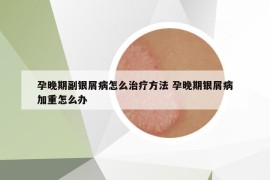 孕晚期副银屑病怎么治疗方法 孕晚期银屑病加重怎么办