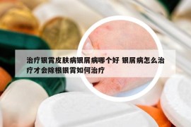 治疗银霄皮肤病银屑病哪个好 银屑病怎么治疗才会除根银霄如何治疗