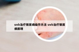 uvb治疗银屑病操作方法 uvb治疗银屑病原理