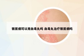 银屑病可以用血毒丸吗 血毒丸治疗银屑病吗