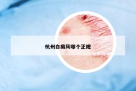 杭州白癜风哪个正规