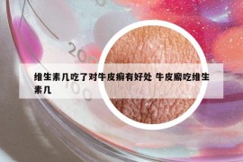 维生素几吃了对牛皮癣有好处 牛皮廨吃维生素几