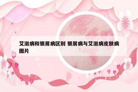 艾滋病和银屑病区别 银屑病与艾滋病皮肤病图片