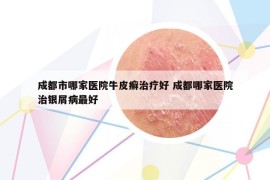 成都市哪家医院牛皮癣治疗好 成都哪家医院治银屑病最好