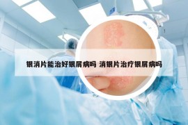 银消片能治好银屑病吗 消银片治疗银屑病吗