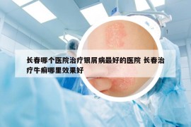 长春哪个医院治疗银屑病最好的医院 长春治疗牛癣哪里效果好