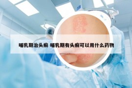 哺乳期治头癣 哺乳期有头癣可以用什么药物