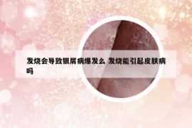 发烧会导致银屑病爆发么 发烧能引起皮肤病吗