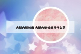 大腿内侧长癣 大腿内侧长癣用什么药