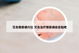 艾灸银屑病穴位 艾灸治疗银屑病自愈贴吧