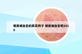 银屑病自愈的真实例子 银屑病自愈吧2019