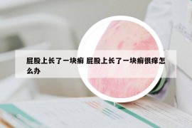 屁股上长了一块癣 屁股上长了一块癣很痒怎么办