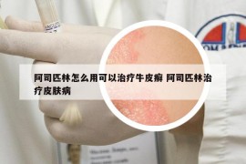 阿司匹林怎么用可以治疗牛皮癣 阿司匹林治疗皮肤病