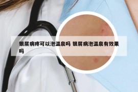 银屑病疼可以泡温泉吗 银屑病泡温泉有效果吗