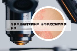 抑制牛皮癣的生物制剂 治疗牛皮肤癣的生物制剂