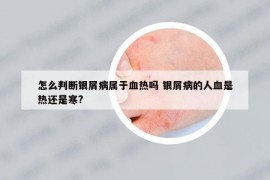 怎么判断银屑病属于血热吗 银屑病的人血是热还是寒?