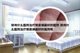 郑州什么医院治疗银屑病最好的医院 郑州什么医院治疗银屑病最好的医院呢