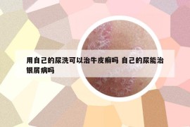 用自己的尿洗可以治牛皮癣吗 自己的尿能治银屑病吗